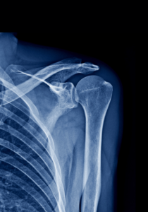 Imaging tests: X rays for shoulder problem