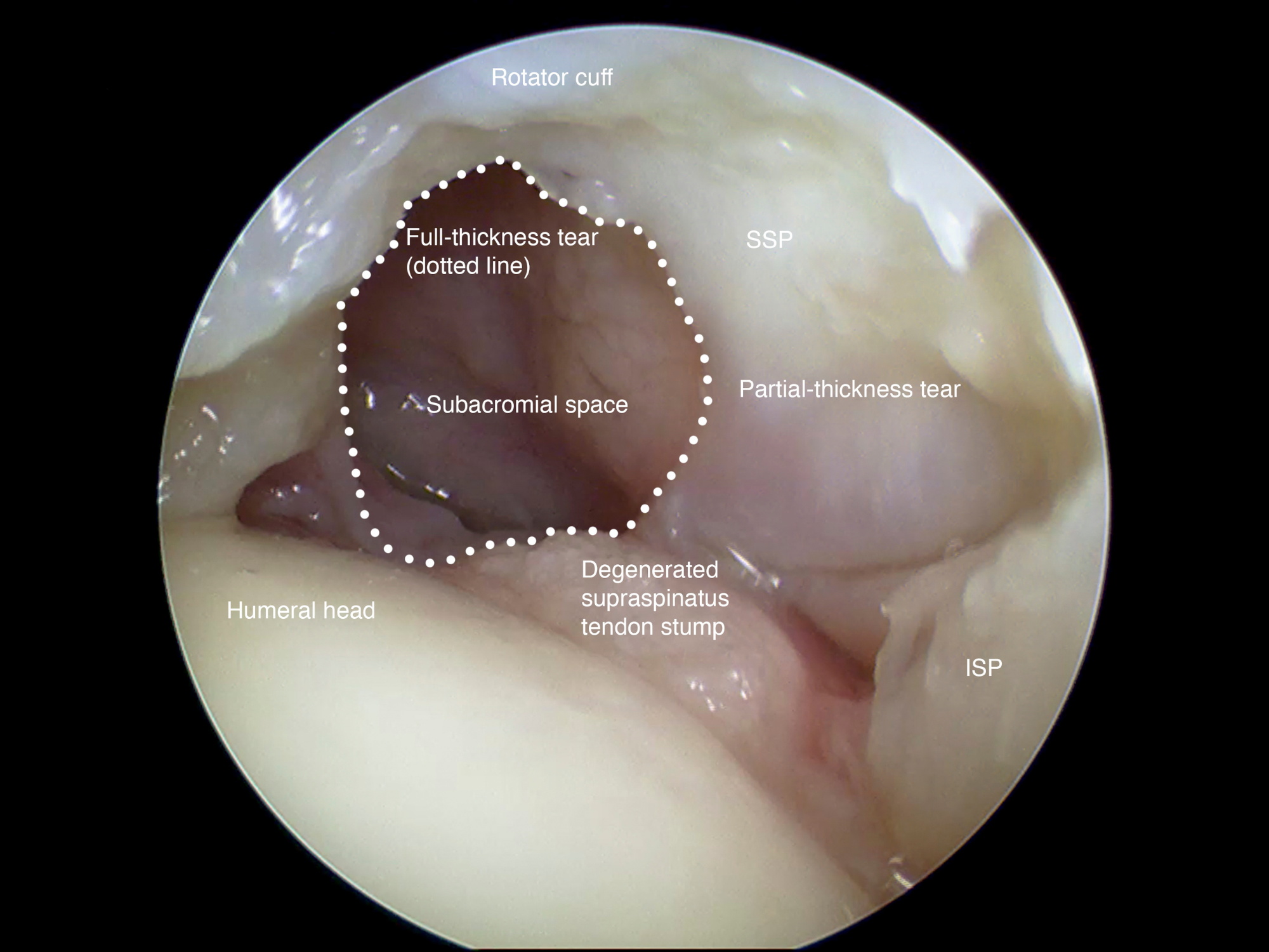 Shoulder scope showing a full thickness tear and partial thickness tear